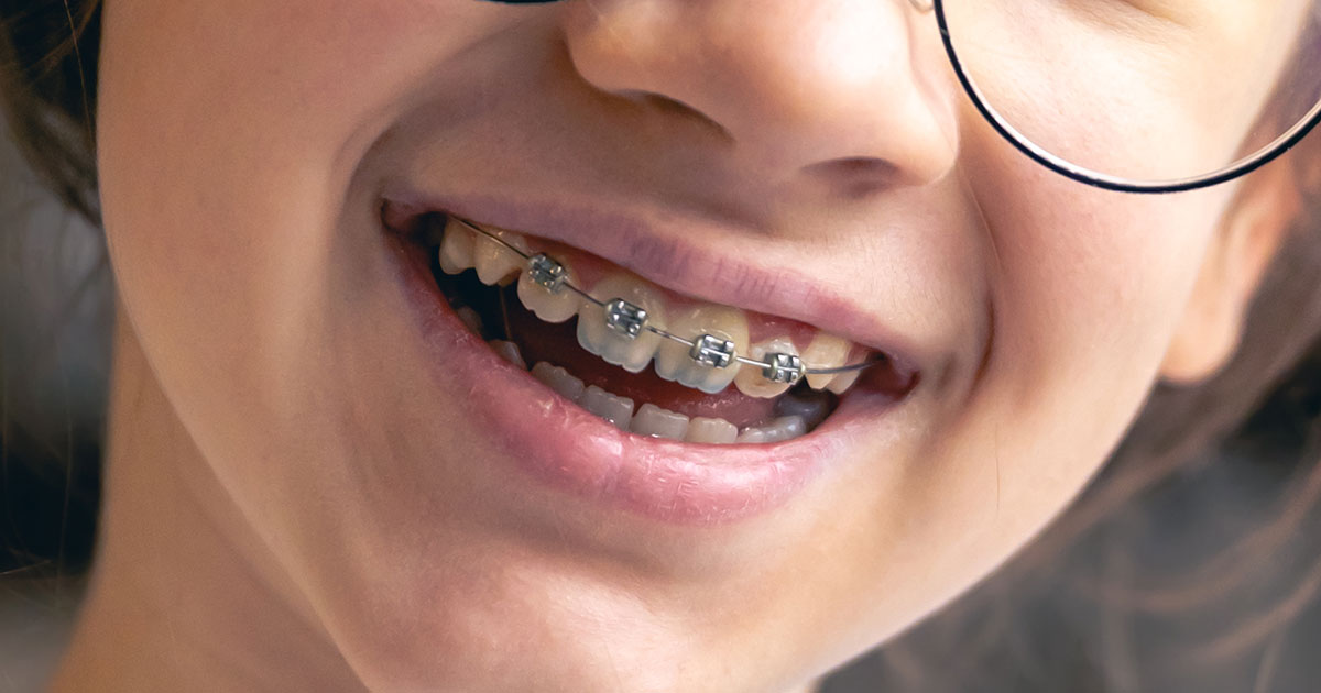 How Early Can My Child Wear Braces? | Pediatric Dentistry Center Philippines